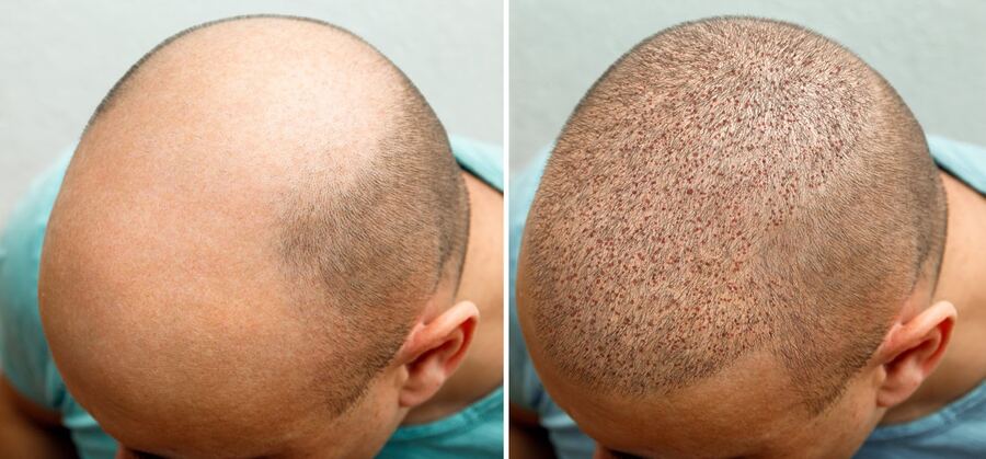 Clinique esthétique Casablanca Greffe de Cheveux - BOTOX Casablanca - FILLER - Épilation Casablanca