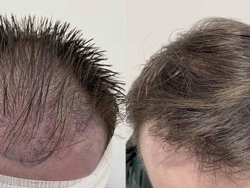 Clinique esthétique Casablanca Greffe de Cheveux - BOTOX Casablanca - FILLER - Épilation Casablanca
