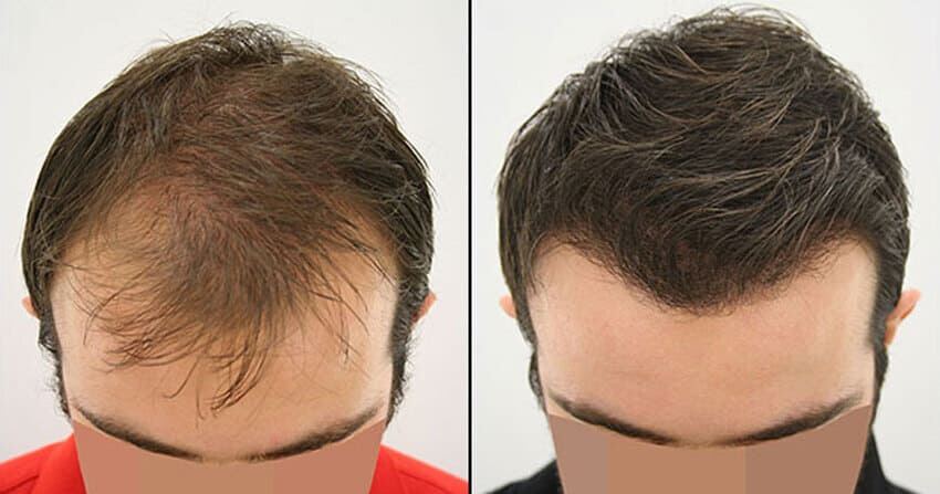 Clinique esthétique Casablanca Greffe de Cheveux - BOTOX Casablanca - FILLER - Épilation Casablanca