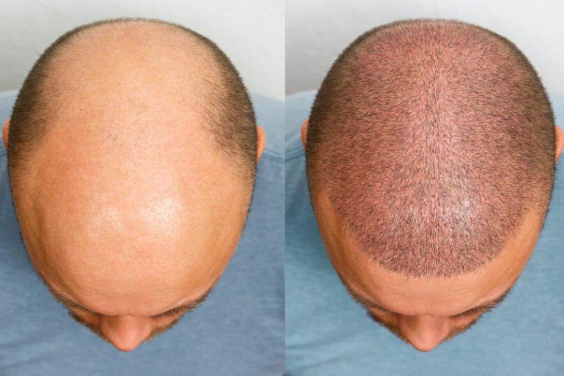 Clinique esthétique Casablanca Greffe de Cheveux - BOTOX Casablanca - FILLER - Épilation Casablanca