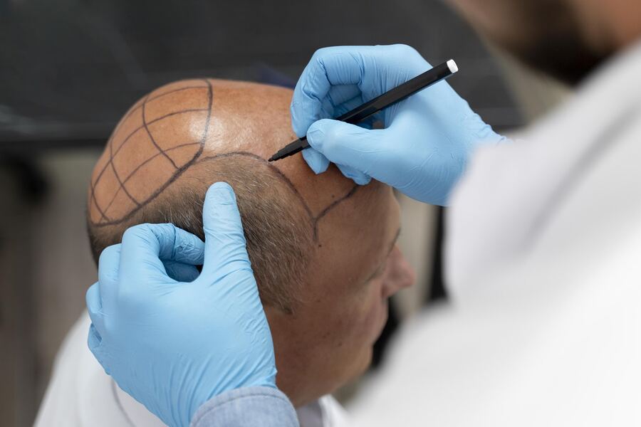 Clinique esthétique Casablanca Greffe de Cheveux - BOTOX Casablanca - FILLER - Épilation Casablanca